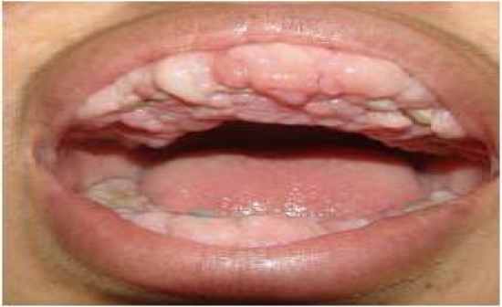 Denture Hyperplasia