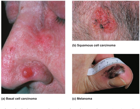 which skin cancer arises from the stratum spinosum cells