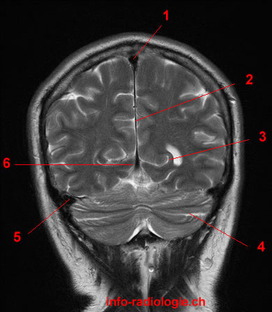 Coronal Fissure