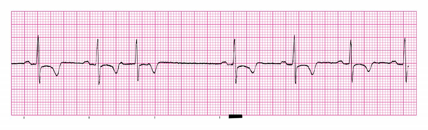 junctional bradycardia rhythm strip