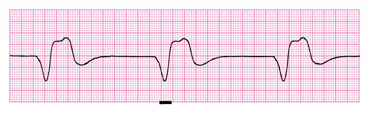 Rhythm Strip Review 2 - ProProfs Quiz