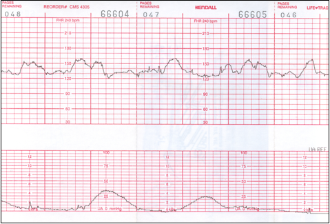 Fetal Heart Monitoring Practice Strips