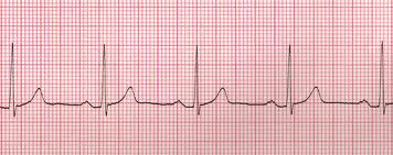 ACLS Rhythm Quiz II - ProProfs Quiz