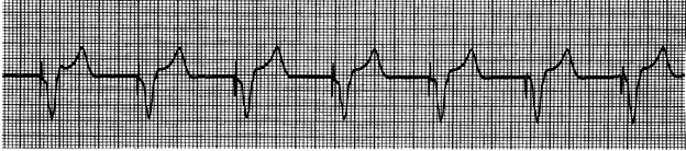 Annual Rhythm Interpreation Exam-part 2: Lethal Rhythm Interpretation ...