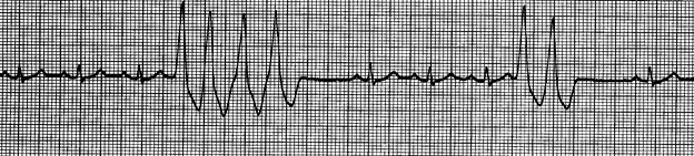 Annual Rhythm Interpreation Exam-part 2: Lethal Rhythm Interpretation 