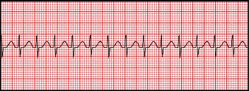 ACLS Rhythm Strips Quiz Test Questions and Answers - Trivia & Questions