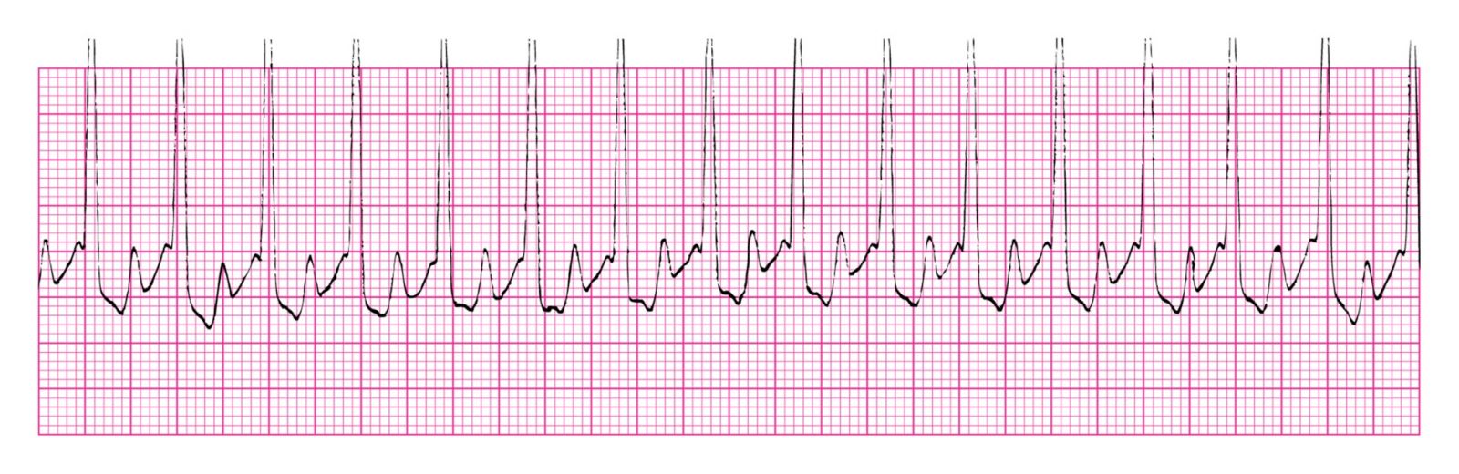 EKG Online Module 6 Quiz | Attempts: 434 - Trivia & Questions