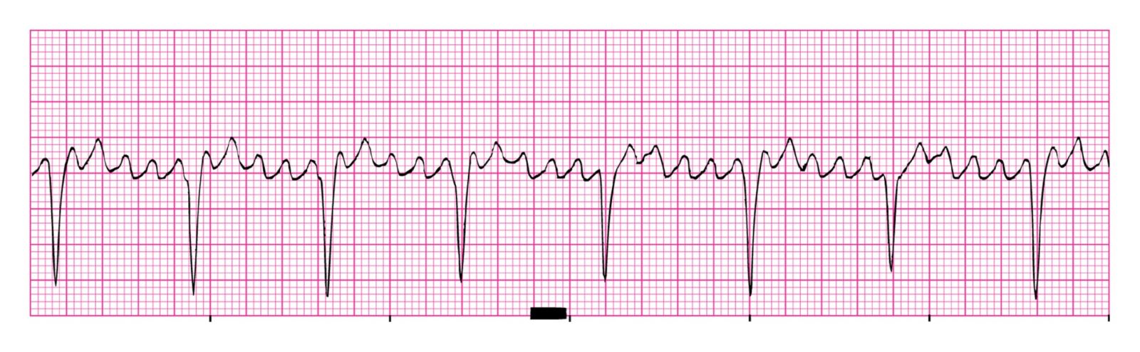 EKG Online Module 6 Quiz - Trivia & Questions