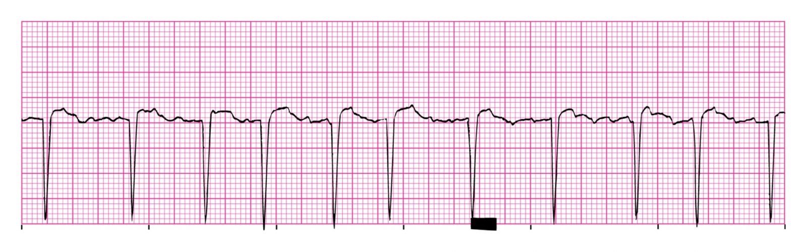 EKG Online Module 6 Quiz | Attempts: 434 - Trivia & Questions