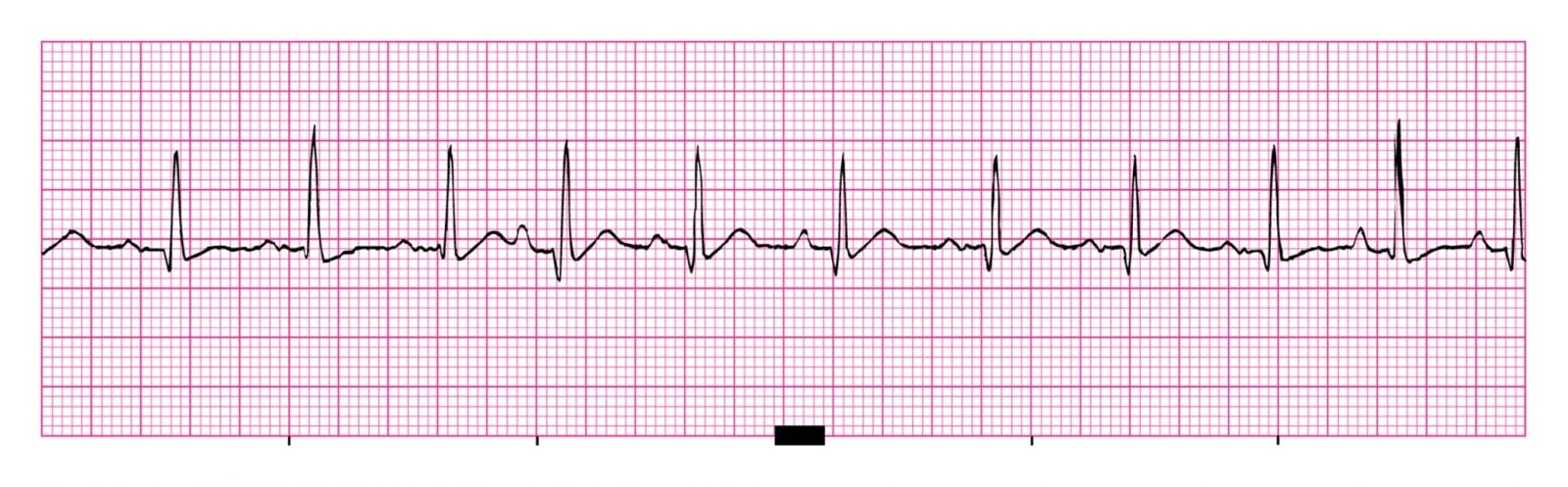 Ekg Online Module 6 Quiz - Trivia & Questions