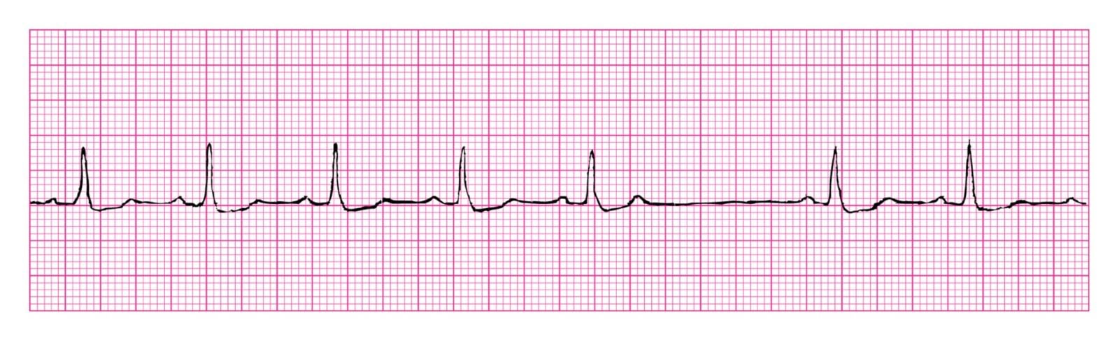 EKG Online Module 6 Quiz - Trivia & Questions