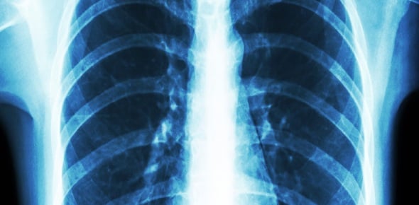 3 Chest Xray Quizzes, Questions, Answers & Trivia - ProProfs