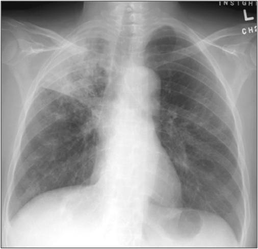 Mycobacterium Tuberculosis: What Do You Know About Fungal Infection ...