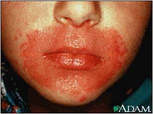 Pharm- Opportunistic Infections Pic Quiz - Trivia & Questions