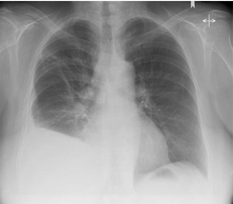 Take The Quiz To Learn About Pleural Effusion - Trivia & Questions