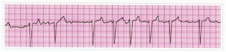 Human Heart Quiz: What Do You Know About Dysrhythmias? | Attempts: 515 ...