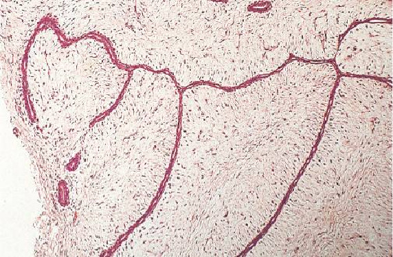 Duct ectasia with inflammatory infiltrates in a 38-year-old woman.