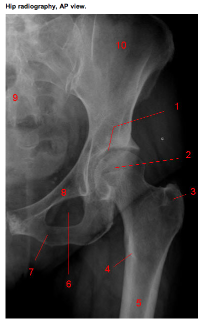 Большое вертело бедренной кости фото. Анатомия вертлужной впадины на рентгене. Вертлужная впадина анатомия кт. Эностоз тазобедренного сустава. Анатомия подвздошной кости рентген.