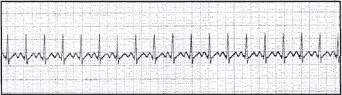 ECG And Heart Beat Show Quiz - ProProfs Quiz