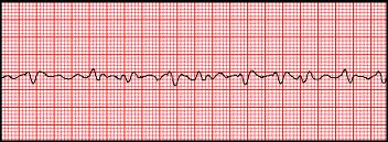 Basic EKG Interpretation, A. Olseth, St Davids - ProProfs Quiz