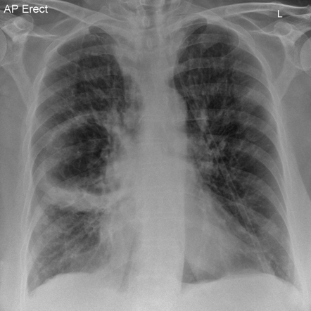 Must Know Chest Xray | Attempts: 2625 - Quiz, Trivia & Questions