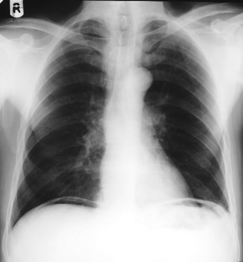 Must Know Chest Xray - Quiz, Trivia & Questions