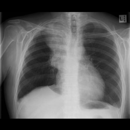 Must Know Chest Xray - Quiz, Trivia & Questions